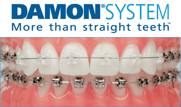 orthodontie enfant et adolescent appareil dentaire estelle baillet la roche sur foron