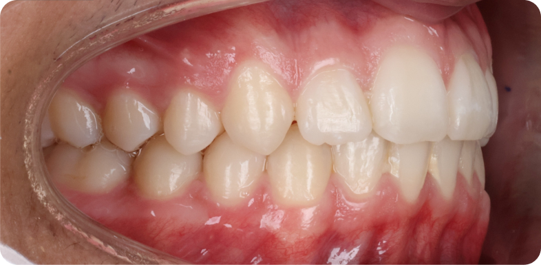 Orthodontie de l'adolescent Orthodontie à La Roche-sur-Foron | Dr Baillet | Artalign