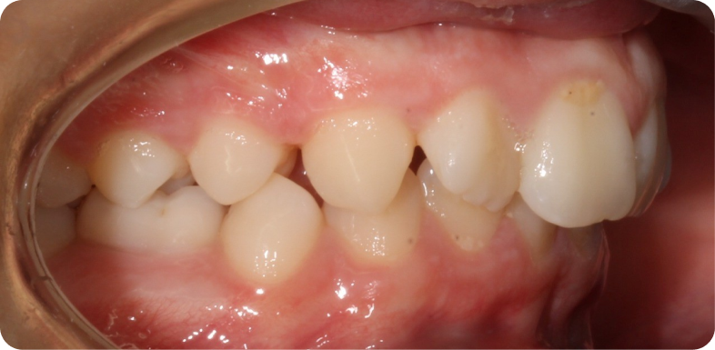Orthodontie de l'adolescent Orthodontie à La Roche-sur-Foron | Dr Baillet | Artalign