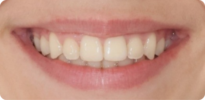 Orthodontie de l'adolescent Orthodontie à La Roche-sur-Foron | Dr Baillet | Artalign