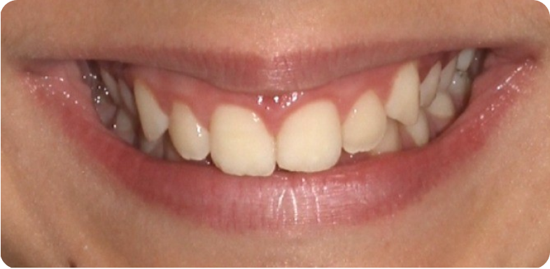 Orthodontie de l'adolescent Orthodontie à La Roche-sur-Foron | Dr Baillet | Artalign