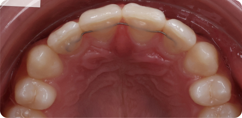 Contention orthodontique Orthodontie à La Roche-sur-Foron | Dr Baillet | Artalign