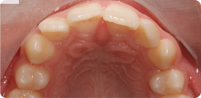 Contention orthodontique Orthodontie à La Roche-sur-Foron | Dr Baillet | Artalign