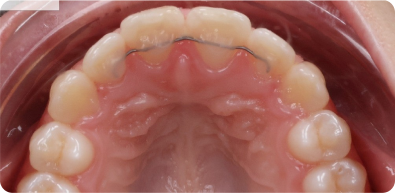 Contention orthodontique Orthodontie à La Roche-sur-Foron | Dr Baillet | Artalign