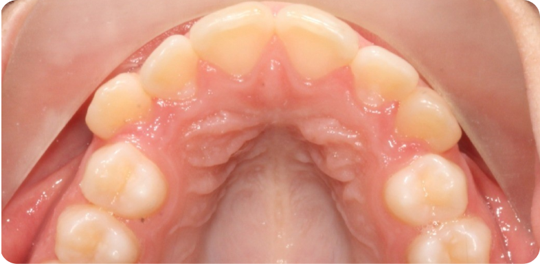 Contention orthodontique Orthodontie à La Roche-sur-Foron | Dr Baillet | Artalign
