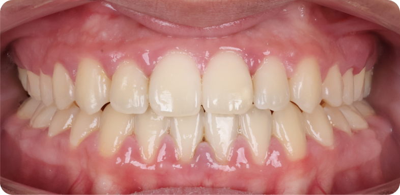 Orthodontie de l'adolescent Orthodontie à La Roche-sur-Foron | Dr Baillet | Artalign