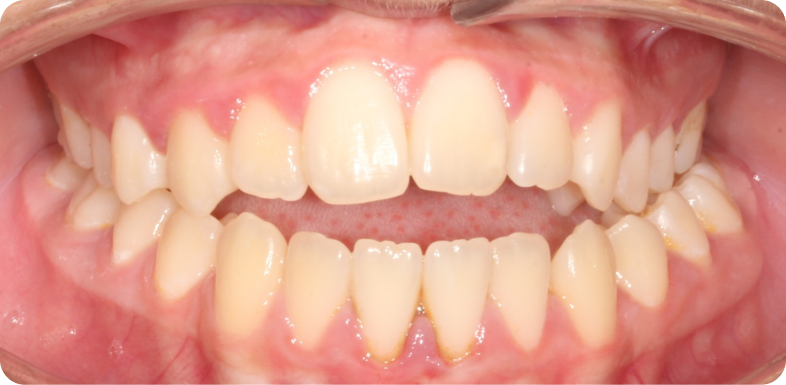 Orthodontie de l'adolescent Orthodontie à La Roche-sur-Foron | Dr Baillet | Artalign