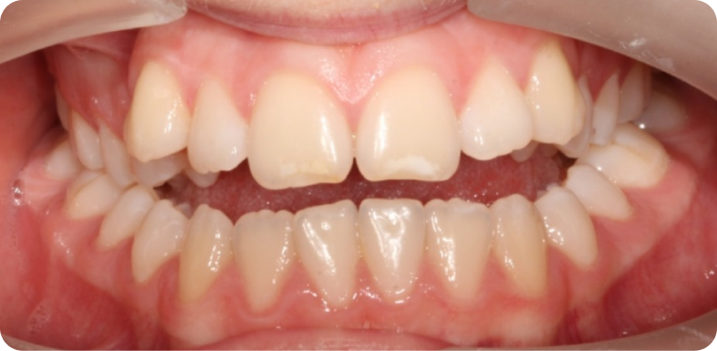 Orthodontie de l'adolescent Orthodontie à La Roche-sur-Foron | Dr Baillet | Artalign