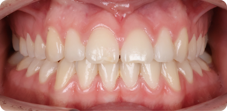 Orthodontie de l'adolescent Orthodontie à La Roche-sur-Foron | Dr Baillet | Artalign