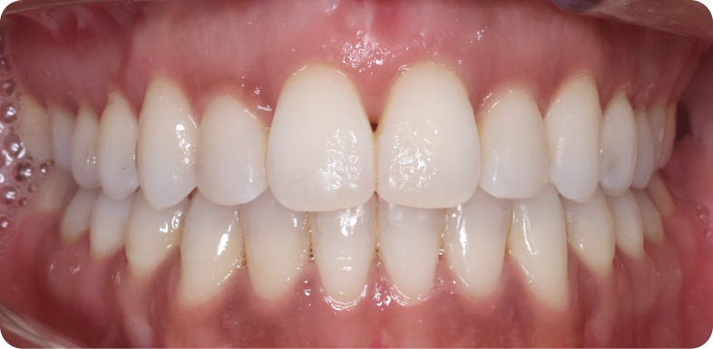 Orthodontie chirurgicale Orthodontie à La Roche-sur-Foron | Dr Baillet | Artalign
