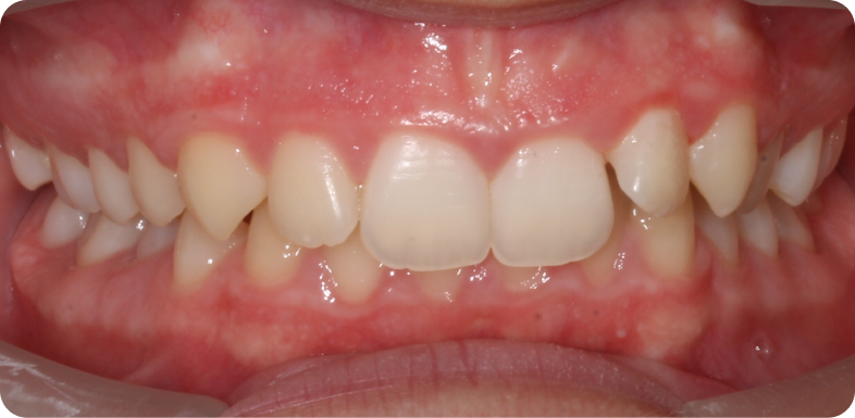 Orthodontie de l'adolescent Orthodontie à La Roche-sur-Foron | Dr Baillet | Artalign