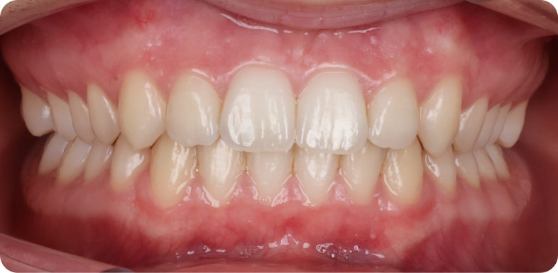Orthodontie de l'adolescent Orthodontie à La Roche-sur-Foron | Dr Baillet | Artalign