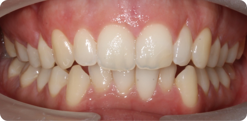 Orthodontie de l'adulte Orthodontie à La Roche-sur-Foron | Dr Baillet | Artalign