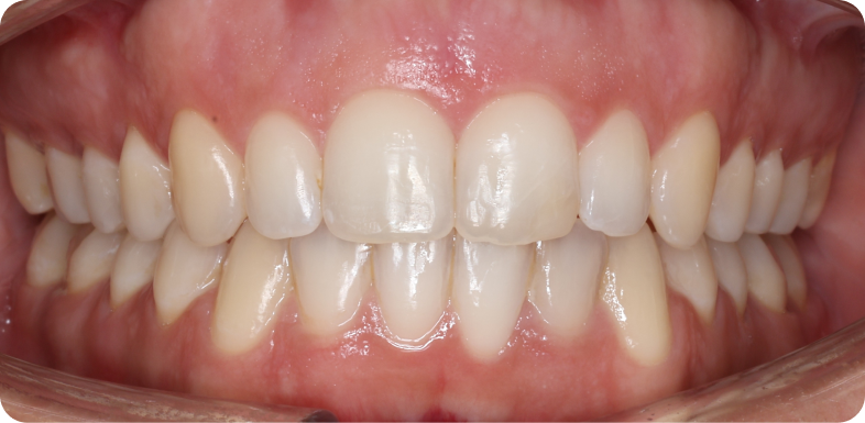 Orthodontie de l'adulte Orthodontie à La Roche-sur-Foron | Dr Baillet | Artalign