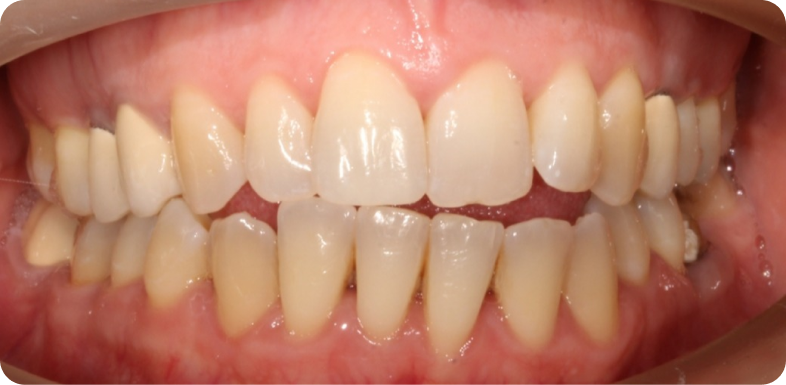 Orthodontie de l'adulte Orthodontie à La Roche-sur-Foron | Dr Baillet | Artalign