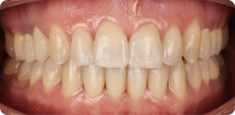 Orthodontie de l'adulte Orthodontie à La Roche-sur-Foron | Dr Baillet | Artalign
