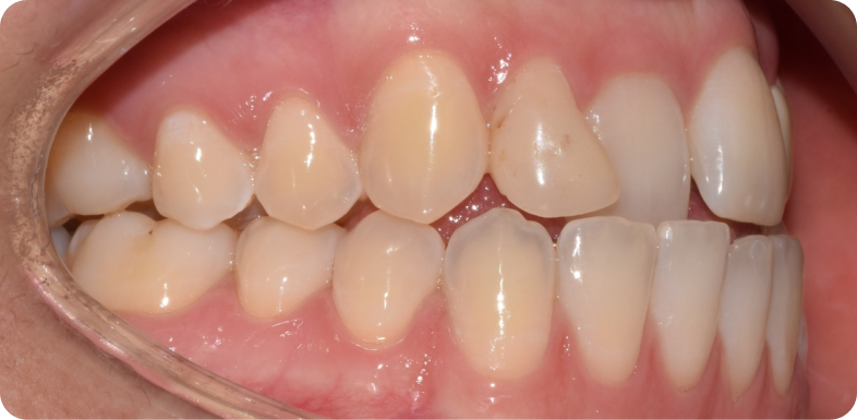 Orthodontie de l'adulte Orthodontie à La Roche-sur-Foron | Dr Baillet | Artalign