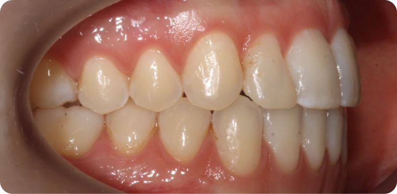 Orthodontie de l'adulte Orthodontie à La Roche-sur-Foron | Dr Baillet | Artalign