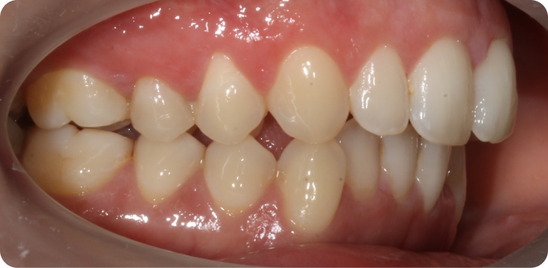 Orthodontie de l'adulte Orthodontie à La Roche-sur-Foron | Dr Baillet | Artalign