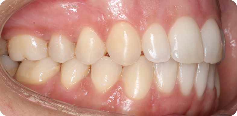 Orthodontie de l'adulte Orthodontie à La Roche-sur-Foron | Dr Baillet | Artalign