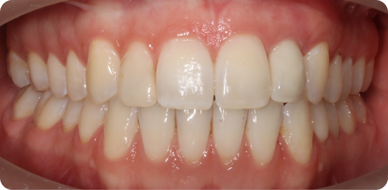Orthodontie chirurgicale Orthodontie à La Roche-sur-Foron | Dr Baillet | Artalign