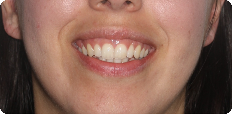 Orthodontie chirurgicale Orthodontie à La Roche-sur-Foron | Dr Baillet | Artalign