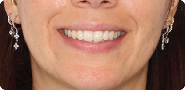Orthodontie chirurgicale Orthodontie à La Roche-sur-Foron | Dr Baillet | Artalign