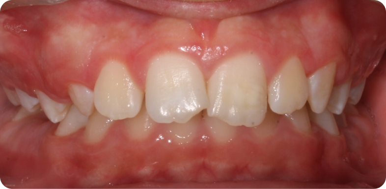 Orthodontie de l'adolescent Orthodontie à La Roche-sur-Foron | Dr Baillet | Artalign
