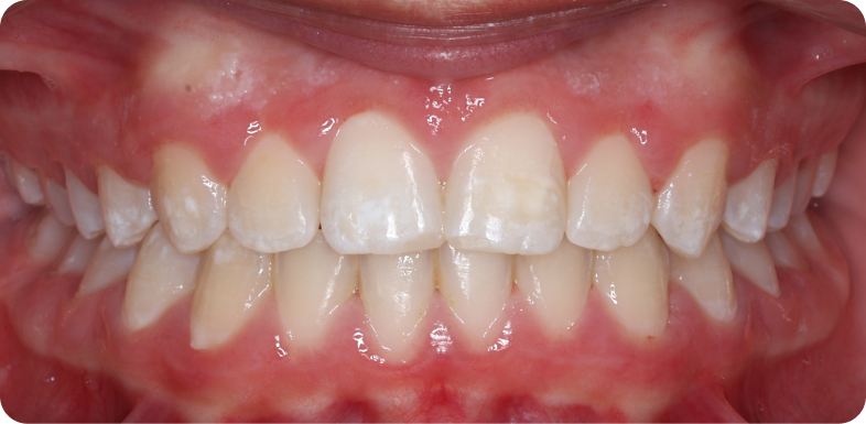 Orthodontie de l'adolescent Orthodontie à La Roche-sur-Foron | Dr Baillet | Artalign