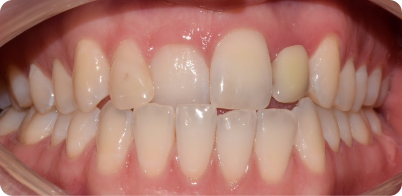 Orthodontie chirurgicale Orthodontie à La Roche-sur-Foron | Dr Baillet | Artalign