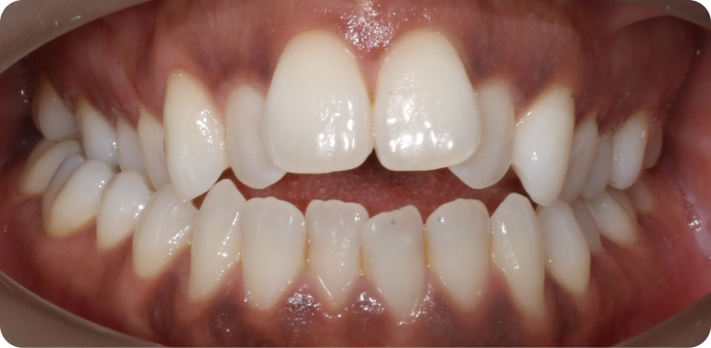 Orthodontie chirurgicale Orthodontie à La Roche-sur-Foron | Dr Baillet | Artalign